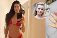 Strach modelky Anety Vignerové: Děsí ji bílé prsty! Má syndrom jako Jirešová