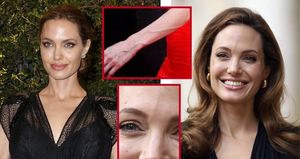 Angelina váží pouhých 44 kg! Její nízká váha odkrývá nevzhledné žíly, které Angelině hyzdí obličej, krk i ruce!