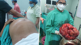 Indovi (45) odoperovali desetikilový nádor! Břicho mu vyrostlo do obřích rozměrů