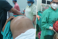 Indovi (45) odoperovali desetikilový nádor! Břicho mu vyrostlo do obřích rozměrů