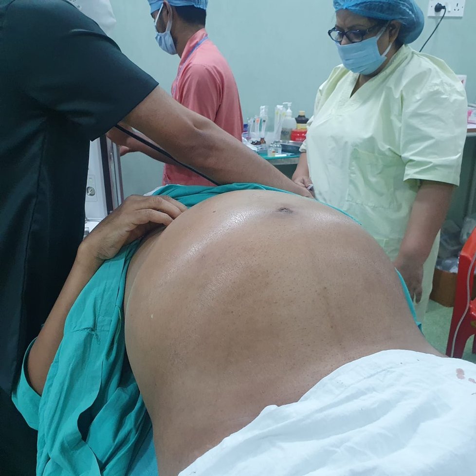 Indovi (45) odoperovali desetikilový nádor! Břicho mu vyrostlo do obřích rozměrů.