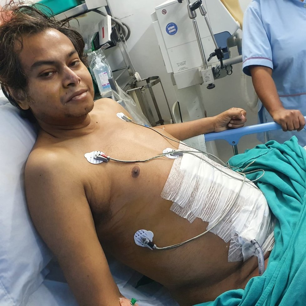 Indovi (45) odoperovali desetikilový nádor! Břicho mu vyrostlo do obřích rozměrů.
