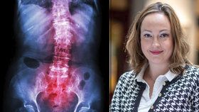 Nina (32) trpí ankylozující spondylitidou, její nemoc jí přináší téměř každodenní bolesti. Navíc je spojená s častějšími záněty v těle