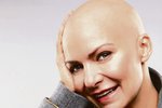 Rakovina a následná chemoterapie připravily zpěvačku Annu K. o vlasy