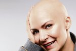Anna K. po chemoterapii přišla o vlasy