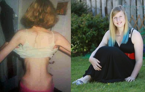 Děsivá zpověď anorektičky: Až na smrtelné posteli mi došlo, že chci žít!