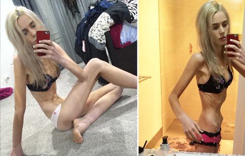 Anorektička (17) vyhladověla kvůli popularitě na 35 kilo. Od smrti ji dělily hodiny