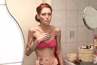 Před smrtí vážila 32 kg: Vymyslela si znásilnění a dostala anorexii