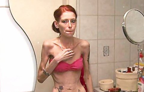 Před smrtí vážila 32 kg: Vymyslela si znásilnění a dostala anorexii