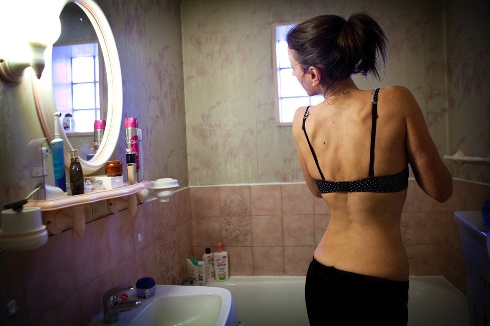 Mladá žena Antonie o boji s mentální anorexií: „Hlavním manipulátorem je vaše mysl.“ (ilustrační foto)