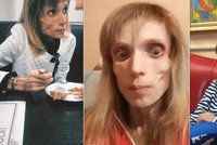 Kost a kůže. Tahle slečna (26) váží pouhých 17 kilo! Jak je to možné?