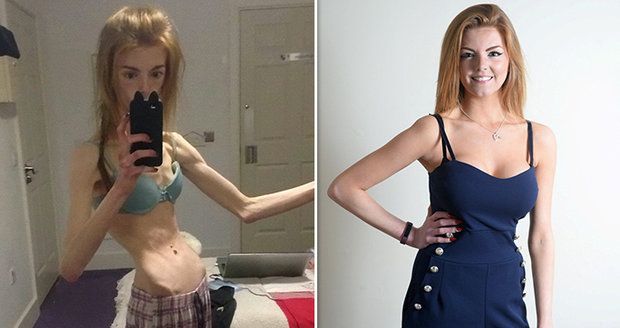 Bloggerka (21) vážila pouhých 28,5 kg! Vyhrát nad anorexii jí pomohly čokoládové bonbony