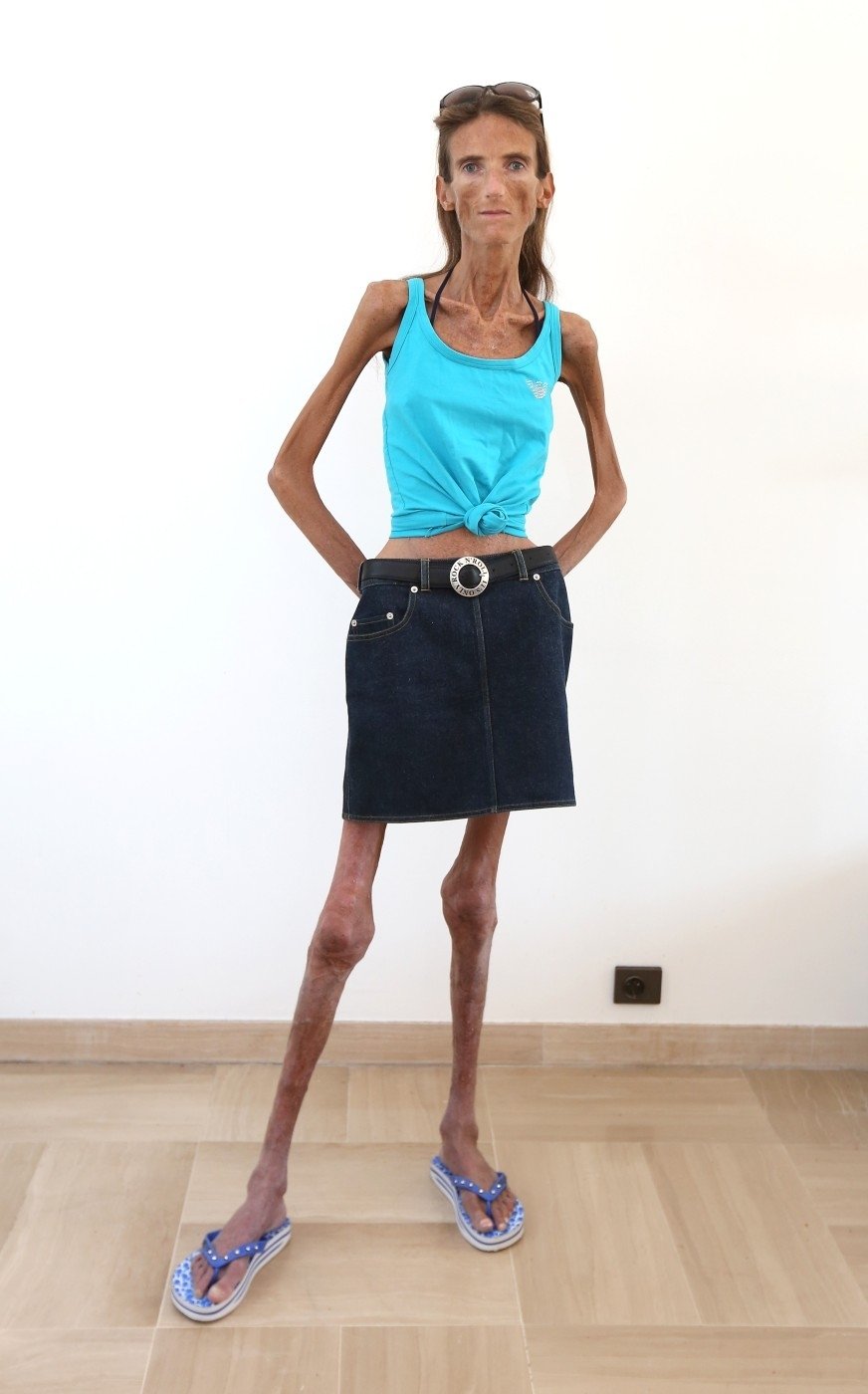 Valeria Levitin (39) je se svými 26,5 kilogramy čtvrtou nejhubenější ženou světa.