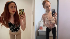 Ellie Spofforth ze Shetlandu ve Skotsku svedla těžký boj s anorexií.