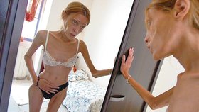I takhle dopadá touha být štíhlá. Francouzka Isabelle Caro vážila ke konci svého života pouhých 31 kilo při 164 cm výšky.