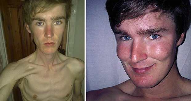 Anorexií trpí už i desetileté děti. Strach z tloušťky drtí také chlapce