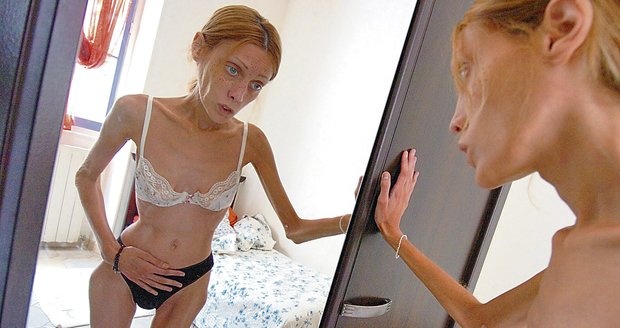 I takhle dopadá touha být štíhlá. Francouzka Isabelle Caro vážila ke konci svého života pouhých 31 kilo při 164 cm výšky.