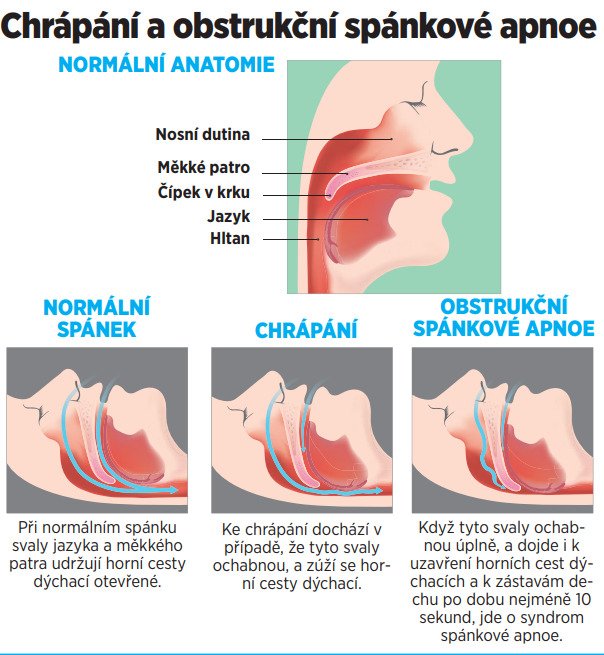 Chrápání a obstrukční spánková apnoe