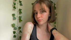 Sestřička Ashling Armstrongová (22) hrdě ukazuje na sociálních sítích lupénku.