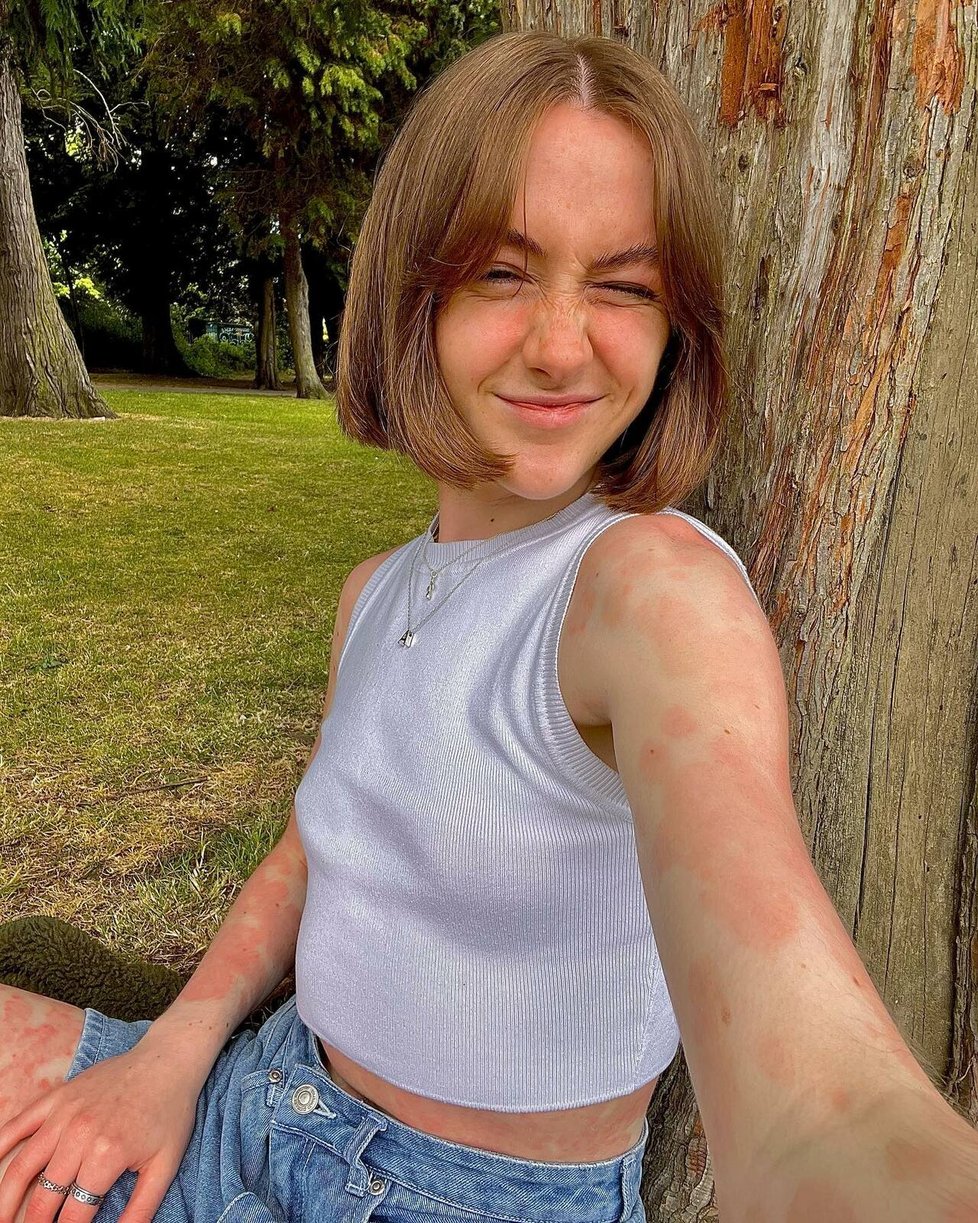 Sestřička Ashling Armstrongová (22) hrdě ukazuje na sociálních sítích lupénku.