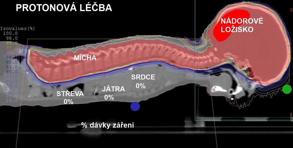 Srovnání ozařovacích plánů pro protonovou léčbu a konvenční radioterapii