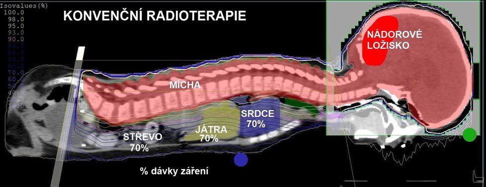 Ozařovací plán konvenční radioterapií.