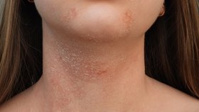 Atopický ekzém nebo také atopická dermatitida je chronické zánětlivé onemocnění kůže. Jeho hlavním projevem je suchá, svědící kůže se sklonem k zánětům, které se projevují začervenáním a tvorbou pupínků a puchýřků, jež mohou mokvat a krvácet. 