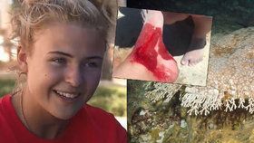 Patnáctiletá dívka unikla žralokovi, odnesla si hluboké kousance na noze.