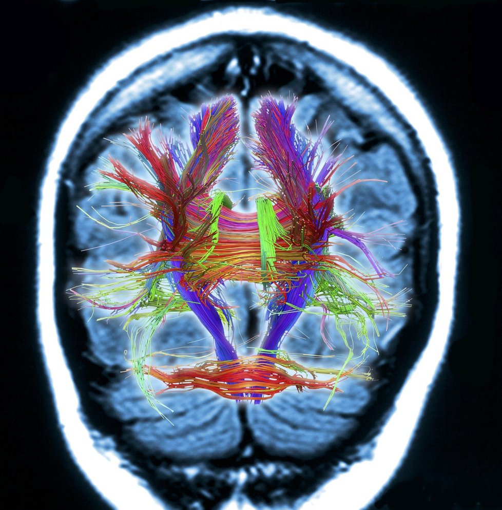 AI je podle skenu z magnetické rezonance zjistit, zda je pacient patří mezi rizikové jedince. (ilustrační foto)