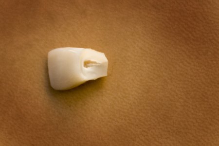 Jeden z vyražených předních zubů poslance Babáka