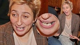 Simona Babčáková předvedla rozpadlý zub.