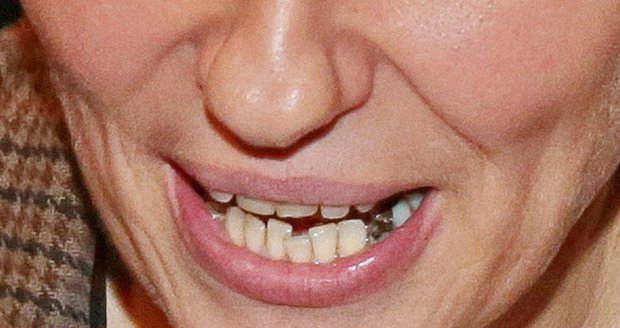 Simona Babčáková má problém se zubem.
