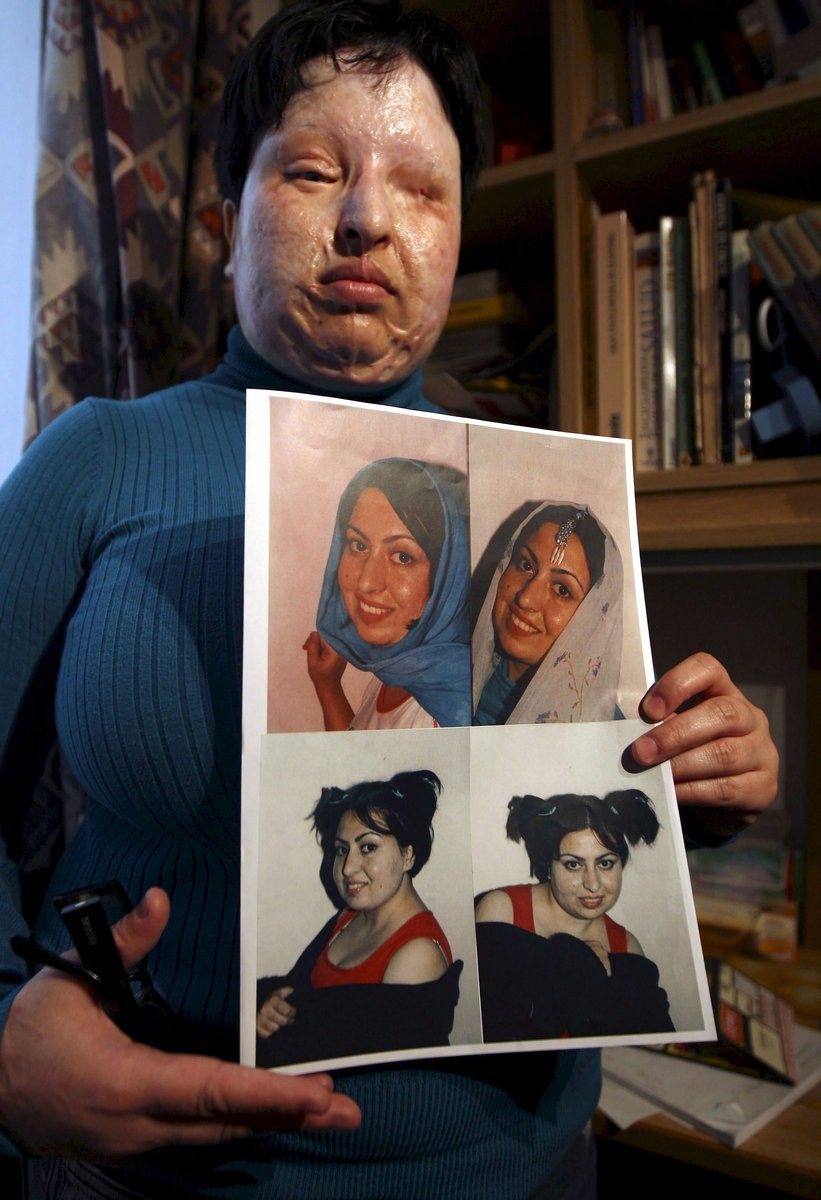 Amené Bahrámí vykoná trest. Oslepí muže, který jí vychrstl kyselinu do obličeje.