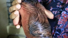 V Bangladéši se narodilo miminko s vráskami. Trpí nejspíš progerií.