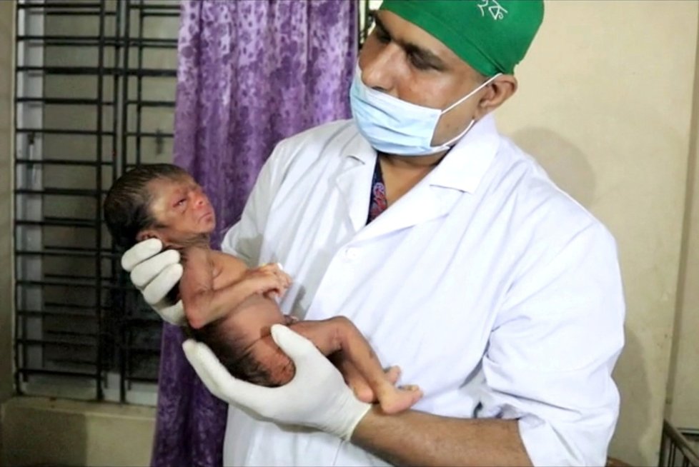 V Bangladéši se narodilo miminko s vráskami. Trpí nejspíš progerií.