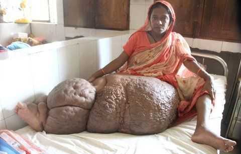 Ženě kvůli parazitovi narostla obří noha. Končetina váží už 60 kilo