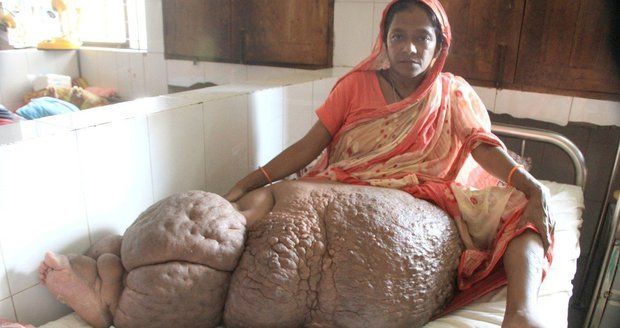 Ženě kvůli parazitovi narostla obří noha. Končetina váží už 60 kilo