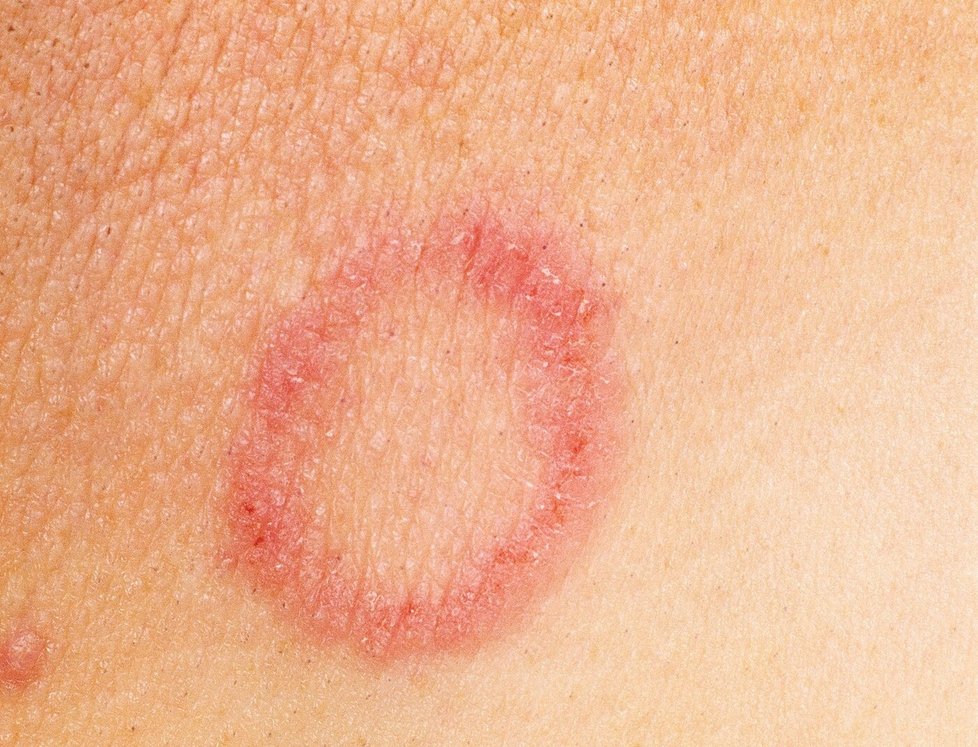 Uces Skin Rash GALERIE: Nový účes, nová plíseň: Kadeřník varuje před oblíbeným ...
