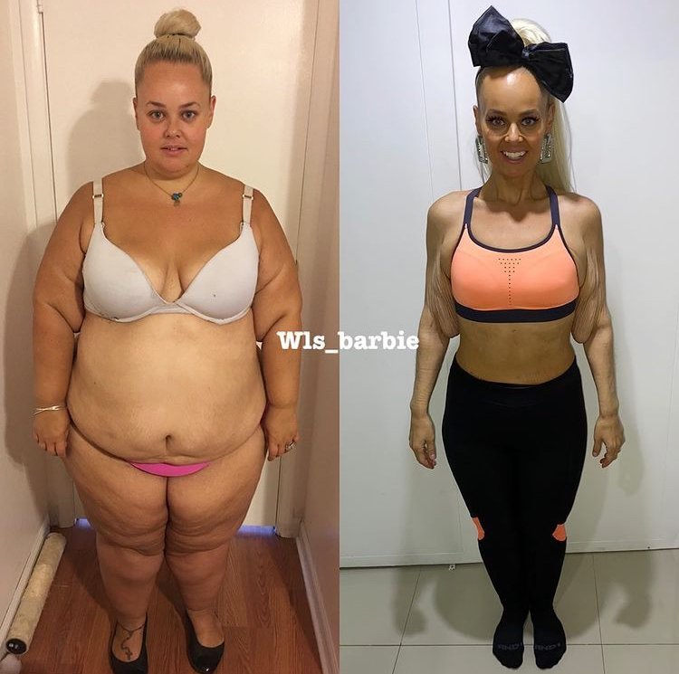 Kayla Lavendeová (36) zhubla 90 kilo poté, co si nechala odstranit 80% svého žaludku.
