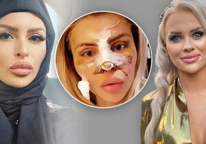 Barbie Jiráčková zavrhla chirurga, který operoval nos Lele Ceterové.