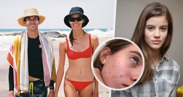 Modelka Podzimková, žena Alberta Černého: Nesnášela sama sebe! Kvůli akné.