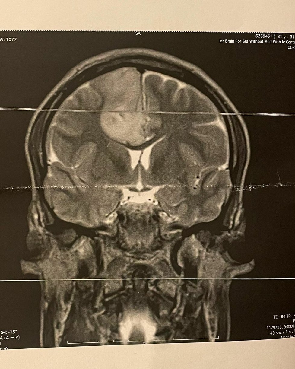 Barton Cowperthwaite ukázal nádor, co mu roste v hlavě.