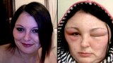 Oběť kosmetiky! Dívka (25) oslepla poté, co si nabarvila vlasy