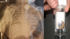 Zkorodovanou baterii v jícnu dítěte odhalil až rentgen (ilustrační foto).