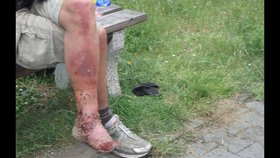 Další případ z Plzně: Červi žrali shnilé maso bezdomovci z nohou zaživa.