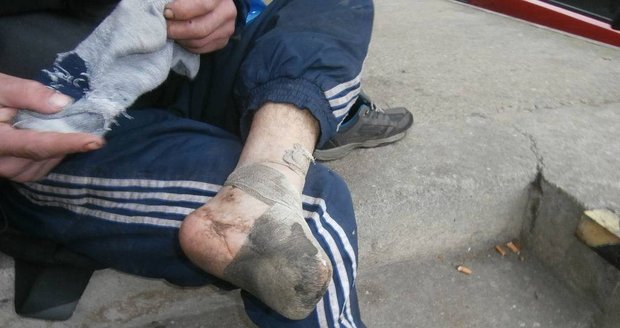 Nechutné! Bezdomovec v Plzni nemohl chodit, strážníkům ukázal zanícený pahýl nohy a omrzlé prsty