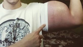 Píchá si injekce s nebezpečnou látkou. Chce mít gigantické bicepsy Píchá si injekce s nebezpečnou látkou. Chce mít gigantické bicepsy