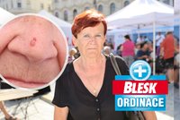 Blesk Ordinace opět pomohla: Paní Heleně (73) odhalili zhoubný nádor kůže!