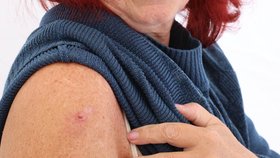 Paní Rybaríková chtěla mít jistotu, že má znaménka v pořádku. Vyklubal se z něj ale nejčastější typ rakoviny kůže – bazaliom.