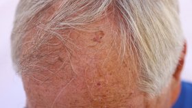 Z měnícího se útvaru na hlavě se vyklubal spinaliom, což je zhoubný kožní nádor, který vzniká na místech, kde nejvíc působí UV záření. Proto je potřeba znaménko co nejdříve odstranit.